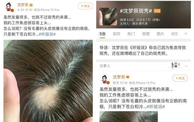 掉发如何治疗？（应对掉发，重拾浓密秀发的秘诀）