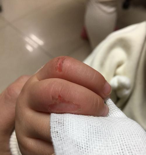 如何妥善处理跑步机擦伤手臂的伤口（快速）