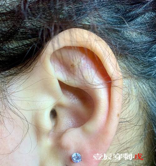 耳蜗充电器底座如何拆卸？拆卸步骤是什么？