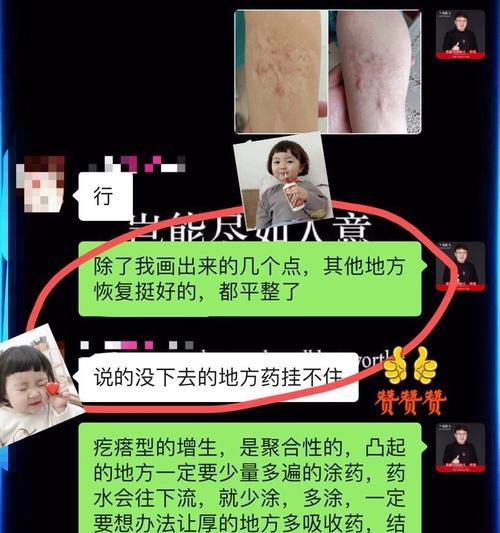 充电器烫伤后如何快速去除疤痕？有哪些有效方法？